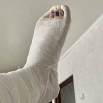 Сольилечанка взыскала компенсацию морального вреда за перелом ноги