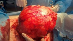 Бригада акбулакских хирургов спасла жизнь пациентке с ущемлением грыжи